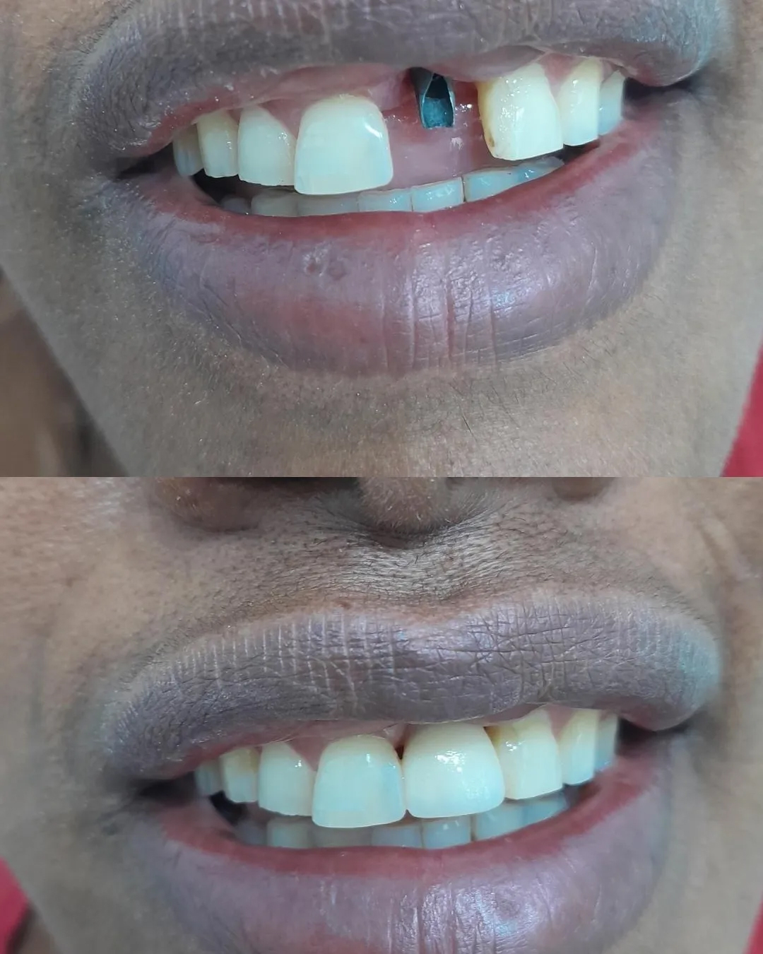 Antes e Depois — Caso 2