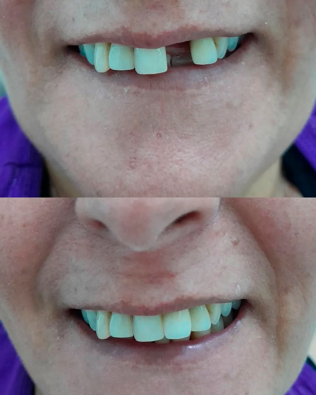 Antes e Depois — Caso 3