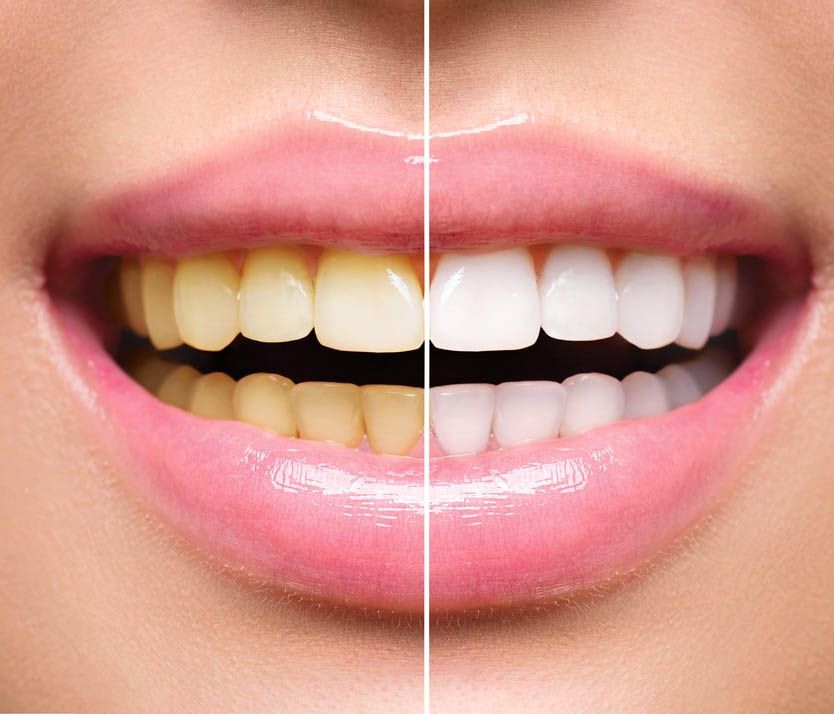 Clareamento dentário